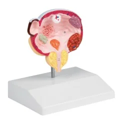 Modèle des maladies de la vessie et de la prostate chez l'homme, taille rée